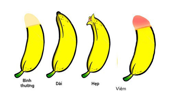 90% hẹp bao quy đầu dễ gây ung thư dương vật, con bạn có bị hẹp không?