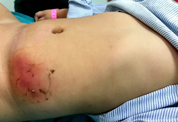 Con bỗng hoại tử vùng bụng do mẹ dán loại cao phổ biến trị mụn