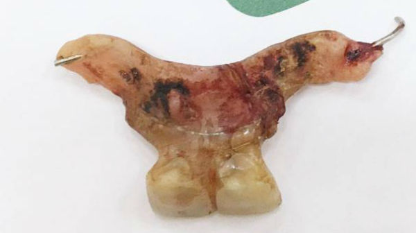 Thủng ruột do nuốt răng giả 2 tháng vì suy nghĩ không giống ai