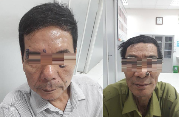 Đi đốt nốt ruồi, 2 người đàn ông bất ngờ phát hiện ung thư