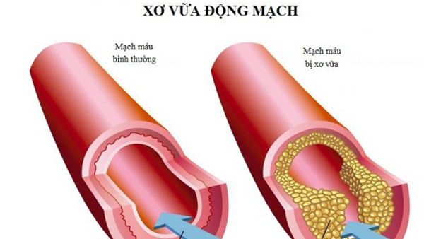 Giải pháp phòng ngừa xơ vữa động mạch từ Nhật Bản