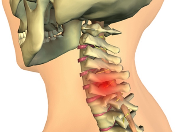 7 triệu chứng thoát vị đĩa đệm cột sống cổ