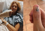 Cắn móng tay, nữ sinh 20 tuổi mắc ung thư da hiếm gặp