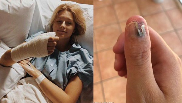 Cắn móng tay, nữ sinh 20 tuổi mắc ung thư da hiếm gặp