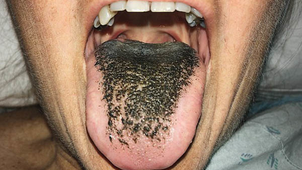 Người phụ nữ sợ hãi vì lưỡi chuyển màu đen như bã chè