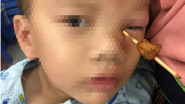 Chạy ra đón bố, bé trai bị que xiên thịt 10cm đâm vào hốc mắt