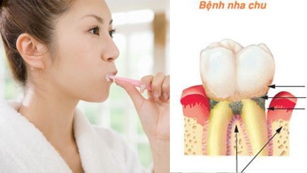 Đánh răng sai cách là nguyên nhân gây ra nhiều bệnh ung thư