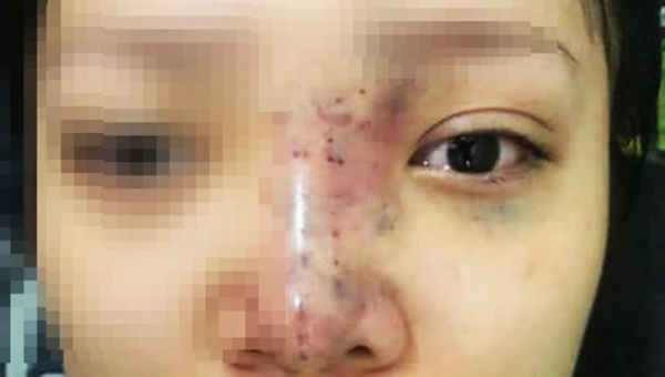 Nữ sinh nguy cơ mù mắt sau khi tiêm filler ở Spa
