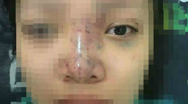 Nữ sinh mù mắt khi tiêm filler: Tiết lộ từ bác sĩ điều trị