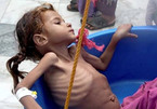Đau lòng cảnh trẻ em Yemen da bọc xương nhai lá cây để sống