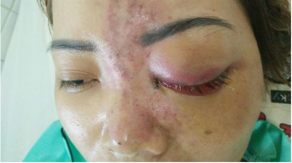 Tiêm filler bị mù mắt: Chỉ xử phạt hành chính spa không phép