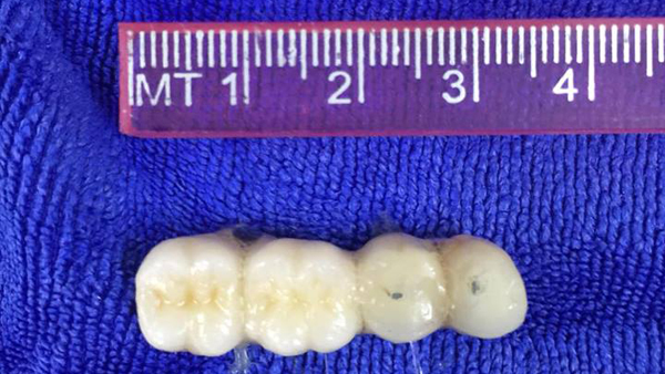 Cụ ông 90 tuổi suýt chết do... răng giả