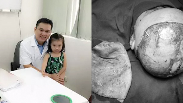 Gặp lại em bé Việt nhỏ tuổi nhất được ghép da đầu khiến bác sĩ sững sờ