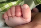 Bé trai 10 tuần tuổi suýt cắt bỏ 4 ngón chân vì sợi tóc rụng của mẹ