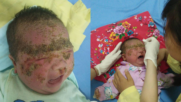 Bé trai bong tróc từng mảng da màu xanh khắp mặt vì lỗi cha mẹ