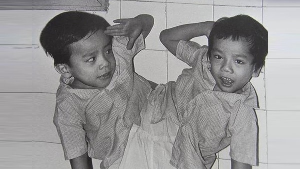 30 năm ngày tách rời cặp song sinh Việt - Đức đi vào lịch sử