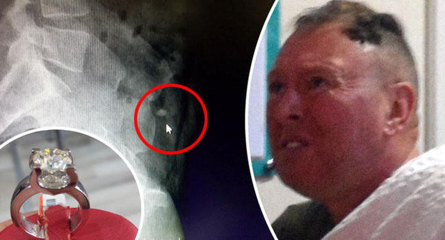 Du khách nuốt vội nhẫn kim cương gần 1 tỷ đồng hòng để phi tang