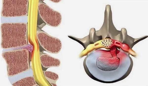 Thoát vị đĩa đệm có chữa khỏi được không?