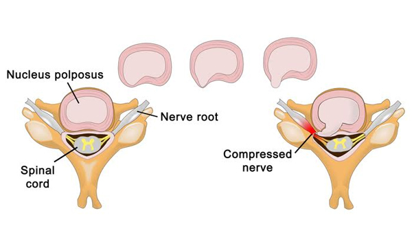 Chỉ là đau lưng, hay trượt đĩa đệm?