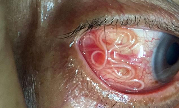 Bác sĩ rùng mình gắp giun dài 15cm ngoe nguẩy trong mắt bệnh nhân