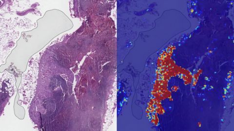Trí tuệ nhân tạo giúp phát hiện ung thư di căn chính xác 99%