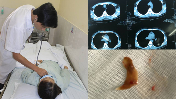 Cô gái ăn thịt vịt, xương đi lạc trong người 3 tháng