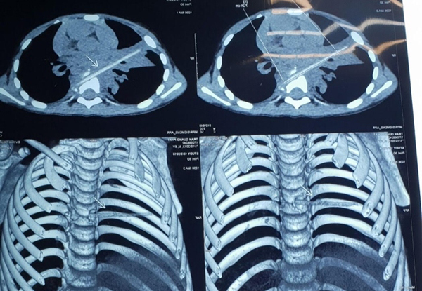 Bé trai bị que xiên thịt đâm xuyên phổi và đốt sống 9 tháng không biết
