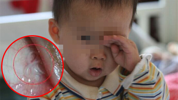 Bé trai 2 tuổi suýt bị mù vĩnh viễn chỉ vì bố mẹ 'lười'