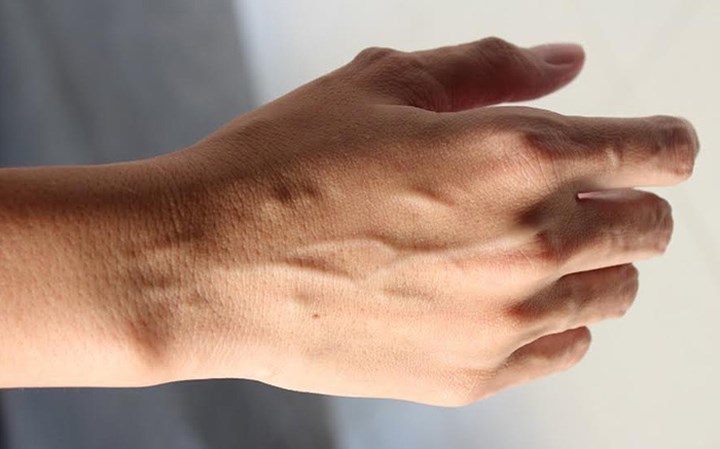Cơ thể bất ngờ nổi gân xanh cảnh bao nguy cơ về vấn đề sức khoẻ của bạn