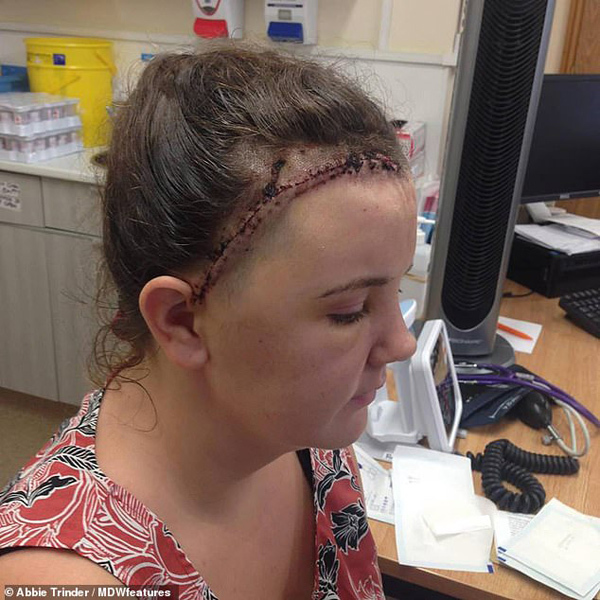 Cô gái 24 tuổi đột ngột bị mù do bỏ qua dấu hiệu này