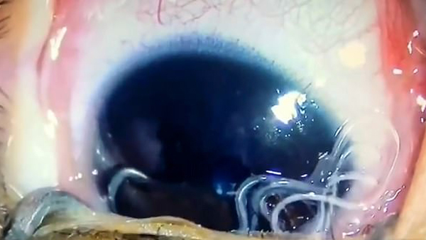 Bác sĩ kinh hãi gắp 11 con giun lúc nhúc trong mắt bé trai
