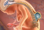 Kỳ diệu: 2 thai nhi được phẫu thuật sửa đốt sống ngay trong bụng mẹ