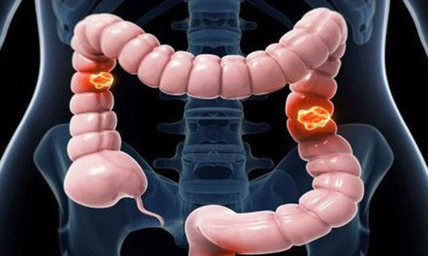 Cảnh báo nguy cơ mắc ung thư từ bệnh viêm đại tràng