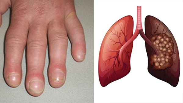 Những dấu hiệu ở móng tay cảnh báo bạn mắc bệnh nặng, có cả ung thư