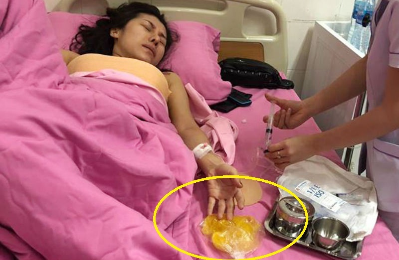 Ca sĩ bolero Ivy Trần nổ túi ngực trên máy bay sau 7 năm bơm silicon
