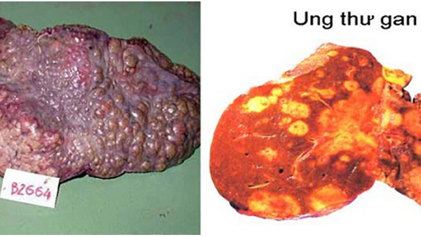 5 nguyên nhân khiến người Việt mắc và chết vì ung thư gan cao thứ 4 thế giới