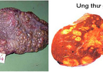 5 nguyên nhân khiến người Việt mắc và chết vì ung thư gan cao thứ 4 thế giới