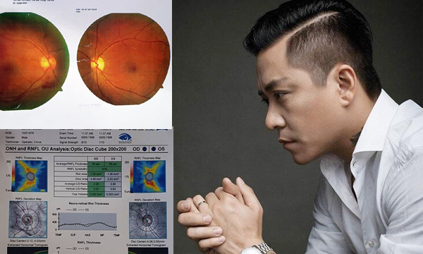 Tuấn Hưng gặp tai nạn sân cỏ, mắt chấn thương nặng