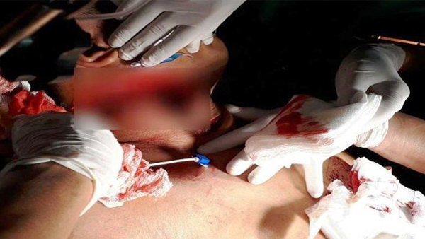Nối ruột cứu sống người đàn ông bị đâm 10 nhát dao