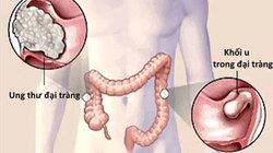 4 triệu người Việt có nguy cơ bị ung thư đại trực tràng