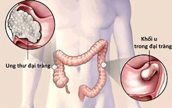 4 triệu người Việt có nguy cơ bị ung thư đại trực tràng