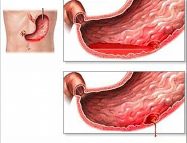 Cảnh báo chảy máu dạ dày bởi món ăn vặt phổ biến mùa lạnh