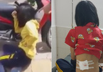 Phú Yên: Công an xác nhận cô gái trúng đạn từ súng cao su của CSGT