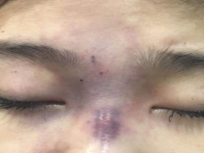 Cô gái ở TP.HCM mù mắt sau khi bạn trai tự tay tiêm filler nâng mũi