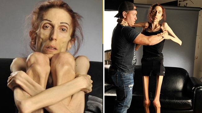 Người phụ nữ thoát khỏi 'tử thần' nhờ tình yêu vĩ đại của chồng