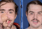 Chàng trai mang khuôn mặt của người khác sau 25 giờ phẫu thuật