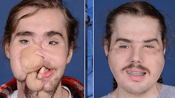 Chàng trai mang khuôn mặt của người khác sau 25 giờ phẫu thuật