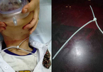 Bé trai 6 tuổi ở Hà Nội nguy kịch vì vòng dây nhựa mang đến lớp