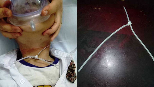 Bé trai 6 tuổi ở Hà Nội nguy kịch vì vòng dây nhựa mang đến lớp