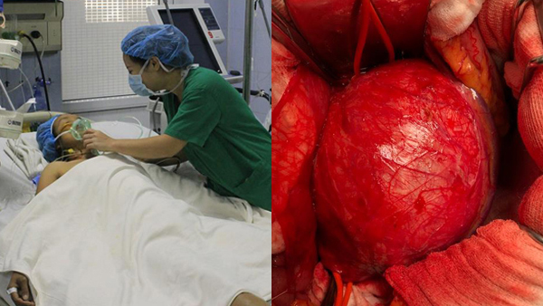 Bác sĩ tròn mắt vì mạch máu nữ bệnh nhân 36 tuổi phình to như cái bát